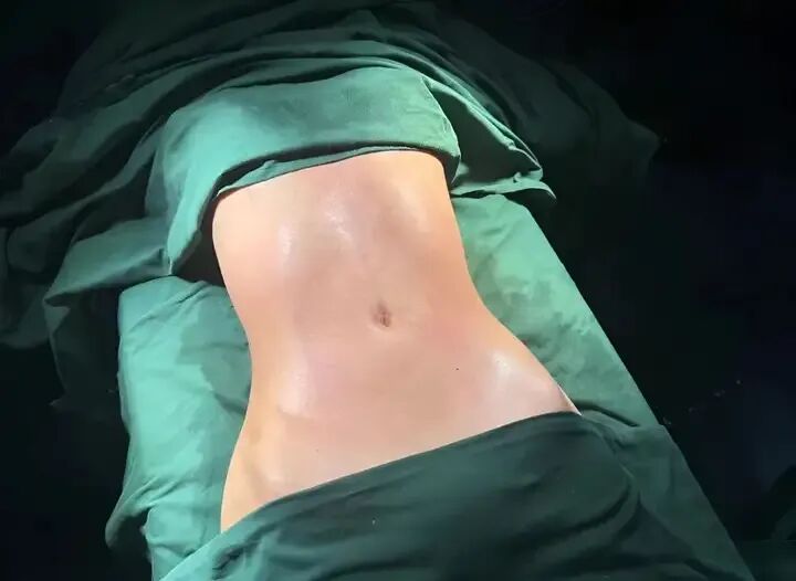 广州吸脂到底选谁?顶尖医生排名与避坑指南插图1 广州吸脂到底选谁?顶尖医生排名与避坑指南插图1