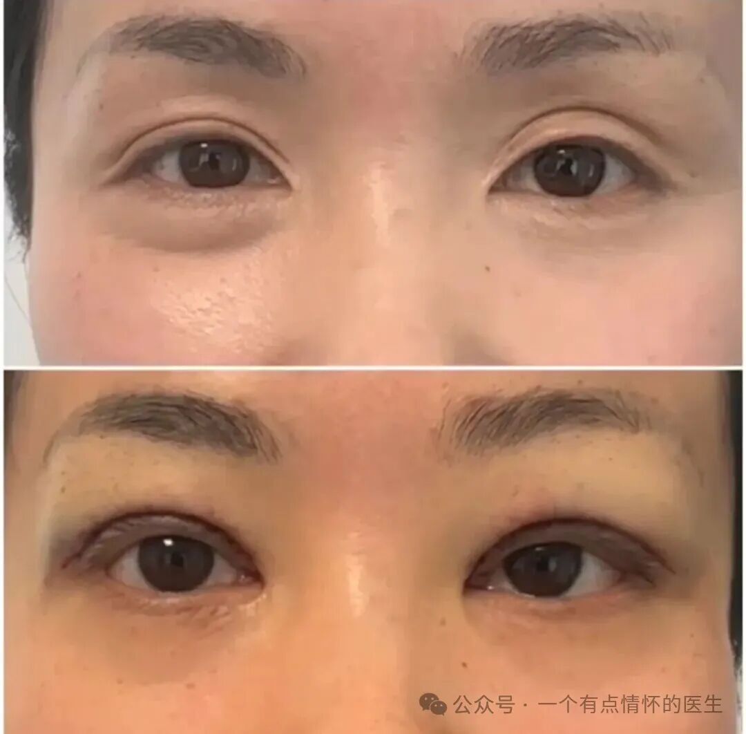 广州眼修复多少钱||广州眼部整形手术费用及注意事项插图 广州眼修复多少钱||广州眼部整形手术费用及注意事项插图