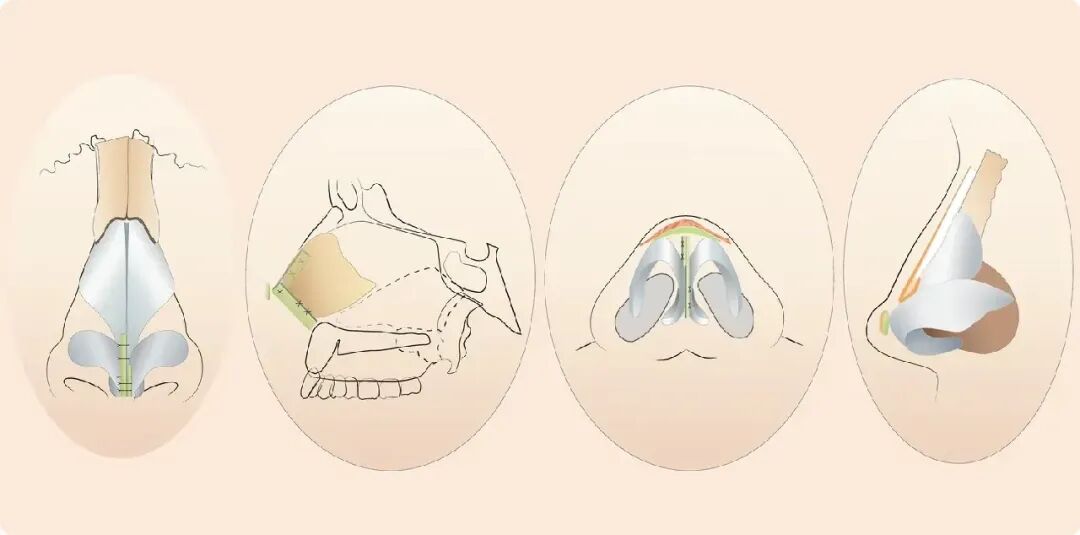 深圳隆鼻修复多少钱?隆鼻手术失败怎么办插图 深圳隆鼻修复多少钱?隆鼻手术失败怎么办插图