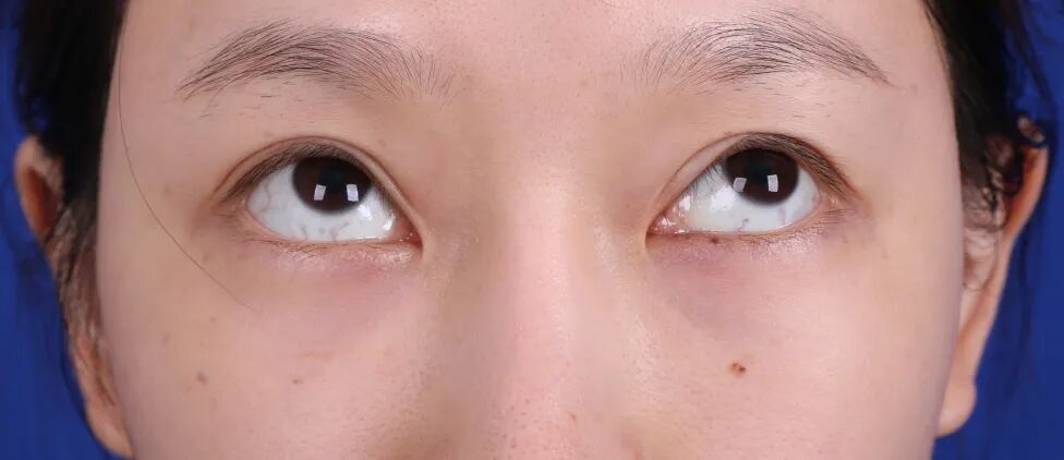 双眼皮失败了还能修复吗?如何有效解决双眼皮手术失败问题插图1 双眼皮失败了还能修复吗?如何有效解决双眼皮手术失败问题插图1