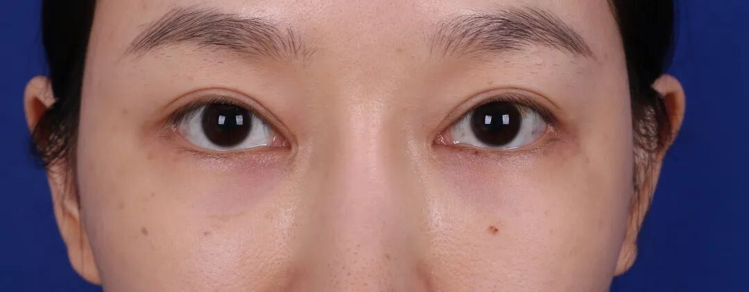双眼皮失败了还能修复吗?如何有效解决双眼皮手术失败问题插图2 双眼皮失败了还能修复吗?如何有效解决双眼皮手术失败问题插图2