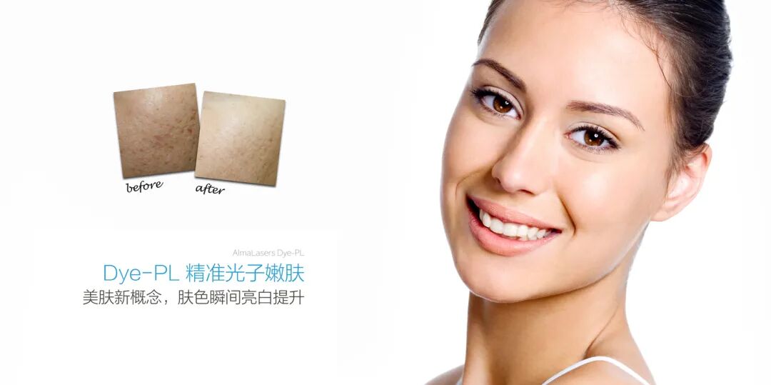北京DPL光子嫩肤价格多少钱?北京DPL光子嫩肤最新优惠信息插图 北京DPL光子嫩肤价格多少钱?北京DPL光子嫩肤最新优惠信息插图
