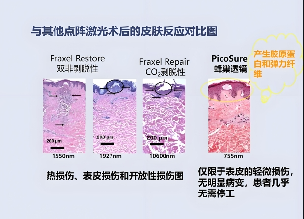 超皮秒祛斑会反弹吗?揭秘真实恢复真相与防复发关键插图 超皮秒祛斑会反弹吗?揭秘真实恢复真相与防复发关键插图