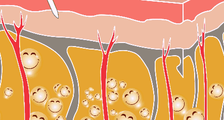 吸脂后到底会不会胖回来？插图1
