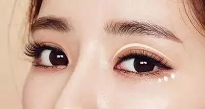 长沙埋线双眼皮多少钱?2026价格表一览插图 长沙埋线双眼皮多少钱?2026价格表一览插图