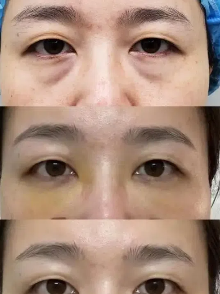北京不开刀去眼袋价格多少钱？北京不手术去除眼袋需要花费多少插图2