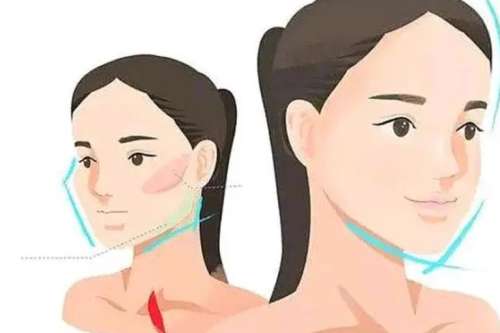 大小脸矫正手术需要多少钱插图