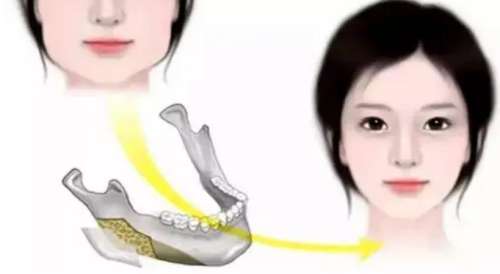 颌骨矫正手术需要多少钱插图1