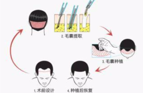 宜昌植发医院哪家口碑好？宜昌市中心人民医院植发技术先进，效果可靠！插图2