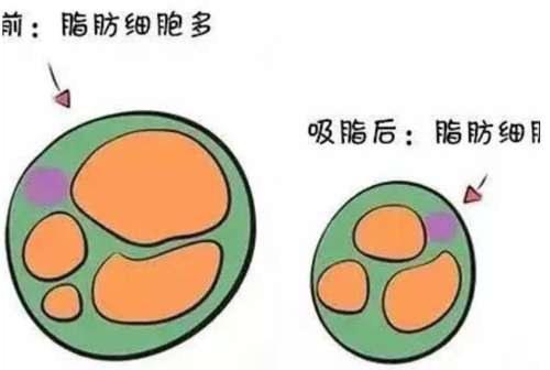 臀部吸脂手术需要多少钱？参考价格是3000元到10000元左右插图1
