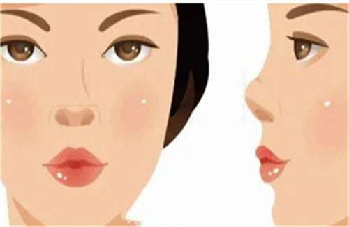 自体软骨隆鼻多少钱？维持时间多久？一文概括插图2