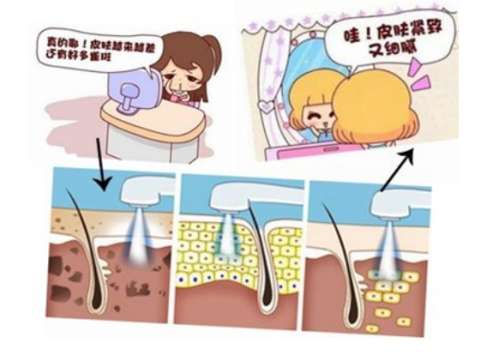 激光祛雀斑价格大概要多少？费用是在3000元到1万元插图