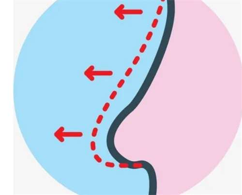 鼻翼缩小手术需要多少钱？收费详情介绍，预览插图1