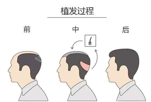 武汉植发多少钱一次?浓密毛发值得拥有插图 武汉植发多少钱一次?浓密毛发值得拥有插图