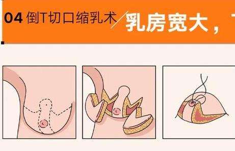 苏州缩胸手术多少钱?哪位医生的技术比较好?会有后遗症吗插图3 苏州缩胸手术多少钱?哪位医生的技术比较好?会有后遗症吗插图3