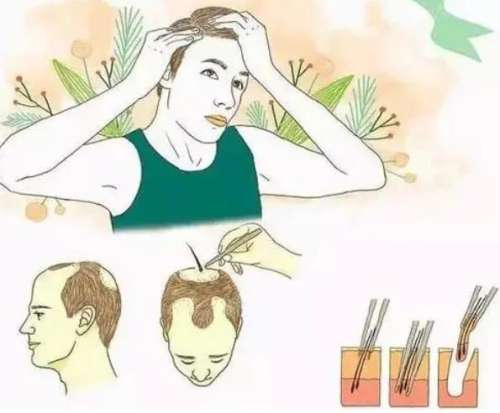 植发三千个单位多少钱插图 植发三千个单位多少钱插图