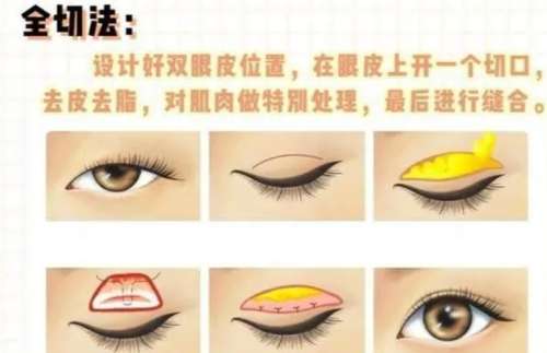 武汉割双眼皮费用一般多少?价格大约在6800元至31,000元插图 武汉割双眼皮费用一般多少?价格大约在6800元至31,000元插图
