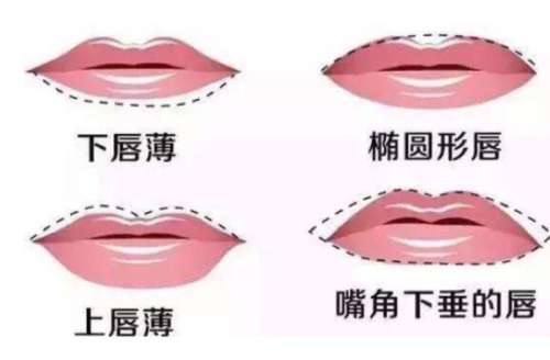 大连市嘟嘟唇玻尿酸多少钱插图 大连市嘟嘟唇玻尿酸多少钱插图