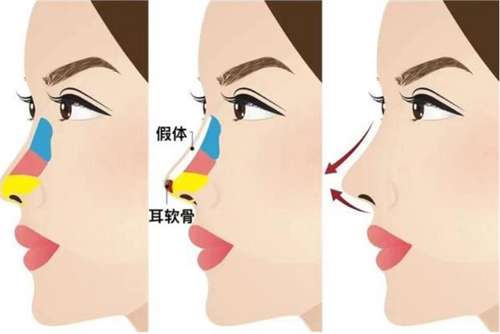 北京隆鼻价格是多少?看全新价格公布,2026年插图3 北京隆鼻价格是多少?看全新价格公布,2026年插图3
