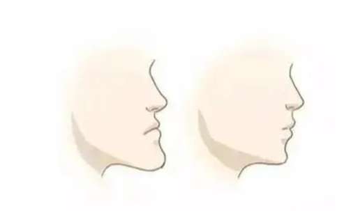 下巴凸出矫正手术要多少钱插图 下巴凸出矫正手术要多少钱插图
