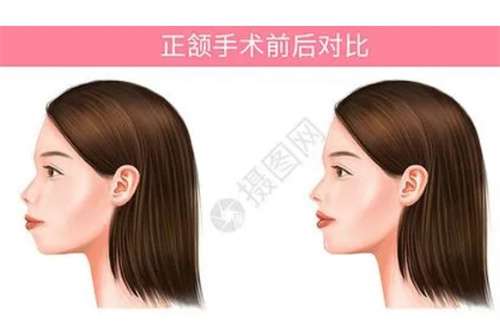 正颌一般多少钱?正颌年龄介绍,术前解析插图3 正颌一般多少钱?正颌年龄介绍,术前解析插图3