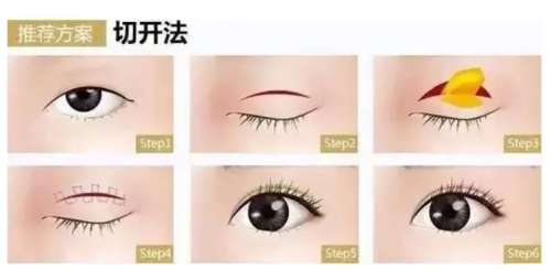 北京割双眼皮大概多少钱?大致在7800元至29,800元插图1 北京割双眼皮大概多少钱?大致在7800元至29,800元插图1