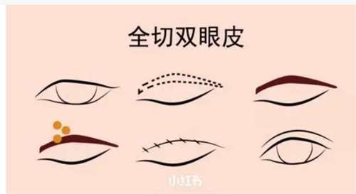 埋线双眼皮比全切双眼皮便宜吗?价格不高还不开刀插图1 埋线双眼皮比全切双眼皮便宜吗?价格不高还不开刀插图1