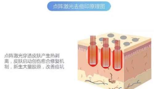 广州南方医院点阵激光价格多少?坐诊医生信息一览!点阵激光案例插图3 广州南方医院点阵激光价格多少?坐诊医生信息一览!点阵激光案例插图3