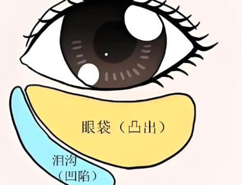 常州去眼袋大约多少钱?价格大拆解!从3k到1.5w差在哪插图 常州去眼袋大约多少钱?价格大拆解!从3k到1.5w差在哪插图