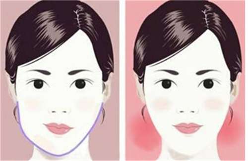 下颌角磨骨整形手术多少钱？多久能恢复？插图3