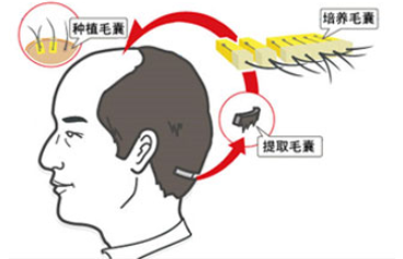 怀化植发医院哪家口碑好？怀化市中医医院植发技术专业，自然浓密！插图2