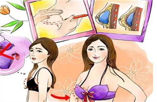 硅胶隆胸一般多少钱?品牌选择、医院选择影响价格插图2 硅胶隆胸一般多少钱?品牌选择、医院选择影响价格插图2