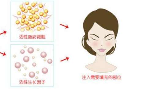 扬州自体脂肪填充多少钱?自体脂肪填充手术医院推荐插图3