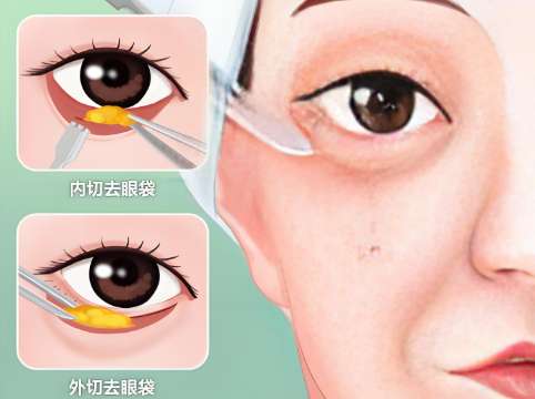 海口做眼袋多少钱?哪些因素在影响定价赶紧看插图 海口做眼袋多少钱?哪些因素在影响定价赶紧看插图