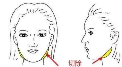 下颌角磨骨手术的费用大概是多少？一般在20000~50000元插图1