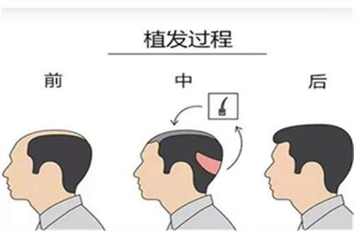 疤痕植发多少钱?价格详细介绍,影响因素发表插图3 疤痕植发多少钱?价格详细介绍,影响因素发表插图3