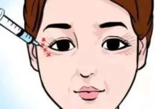 去除鱼尾纹手术多少钱呢？插图1