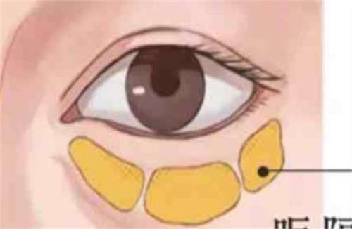 黑龙江瑞丽医疗美容去眼袋价格贵吗?人气医生在线看插图2 黑龙江瑞丽医疗美容去眼袋价格贵吗?人气医生在线看插图2