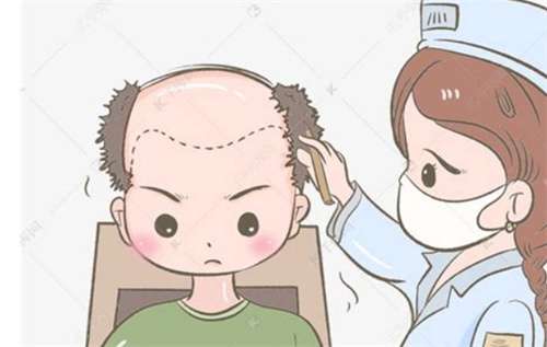 杭州植发价格是多少?看影响价格因素有哪些?插图 杭州植发价格是多少?看影响价格因素有哪些?插图