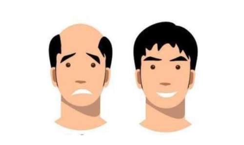 种植发际线一般多少钱啊?大约在10000元至48,000元插图1 种植发际线一般多少钱啊?大约在10000元至48,000元插图1
