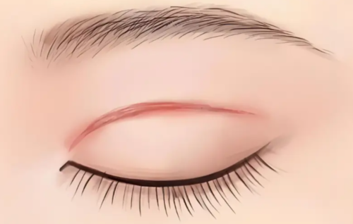 浙一医院沈向前割双眼皮怎么样?术式选择、医生风格和口碑反馈插图 浙一医院沈向前割双眼皮怎么样?术式选择、医生风格和口碑反馈插图