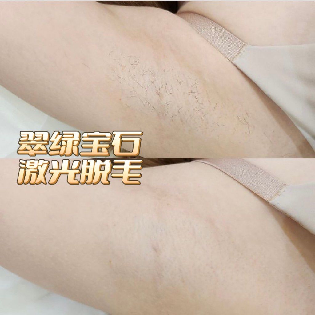 北京激光脱毛预约指南 | 如何在北京高效预约激光脱毛服务插图1 北京激光脱毛预约指南 | 如何在北京高效预约激光脱毛服务插图1