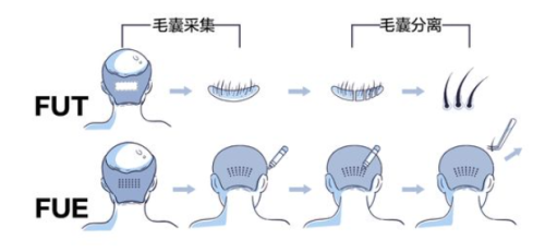 南阳植发医院哪家口碑好?南阳市中心医院植发项目成熟,自然浓密!插图1 南阳植发医院哪家口碑好?南阳市中心医院植发项目成熟,自然浓密!插图1