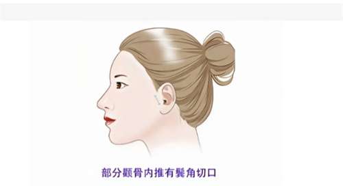颧弓整形多少钱一次?2026年价格公布,一键查询插图2 颧弓整形多少钱一次?2026年价格公布,一键查询插图2