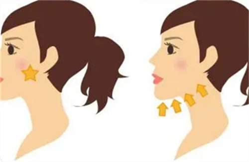 下颌角磨骨整形手术多少钱？多久能恢复？插图