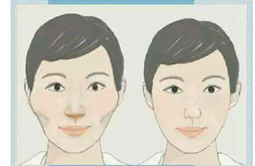 颧骨整形多少钱啊?医院选择影响价格,术前必看插图3 颧骨整形多少钱啊?医院选择影响价格,术前必看插图3