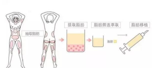 哈尔滨医大一院打水光针多少钱?1000元起,本土热门医院与真假辨别指南插图 哈尔滨医大一院打水光针多少钱?1000元起,本土热门医院与真假辨别指南插图