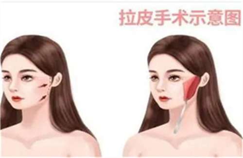 小拉皮手术多少钱一次?赶走皱纹,恢复注意事项公布插图3 小拉皮手术多少钱一次?赶走皱纹,恢复注意事项公布插图3