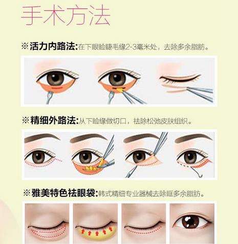 济南去眼袋手术多少钱?参考价格是3000元到8000元左右插图 济南去眼袋手术多少钱?参考价格是3000元到8000元左右插图