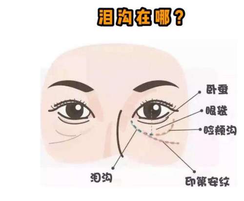 玻尿酸填充泪沟多少钱一次？价格范围是3000元到10000插图1